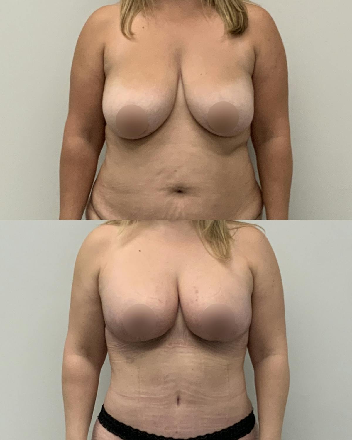 Breast Reduction Before & After Gallery - Patient 254977 - Image 1