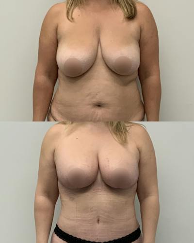 Breast Lift Before & After Gallery - Patient 497777 - Image 1