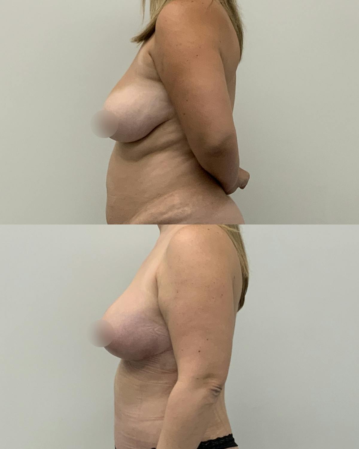 Breast Reduction Before & After Gallery - Patient 254977 - Image 3