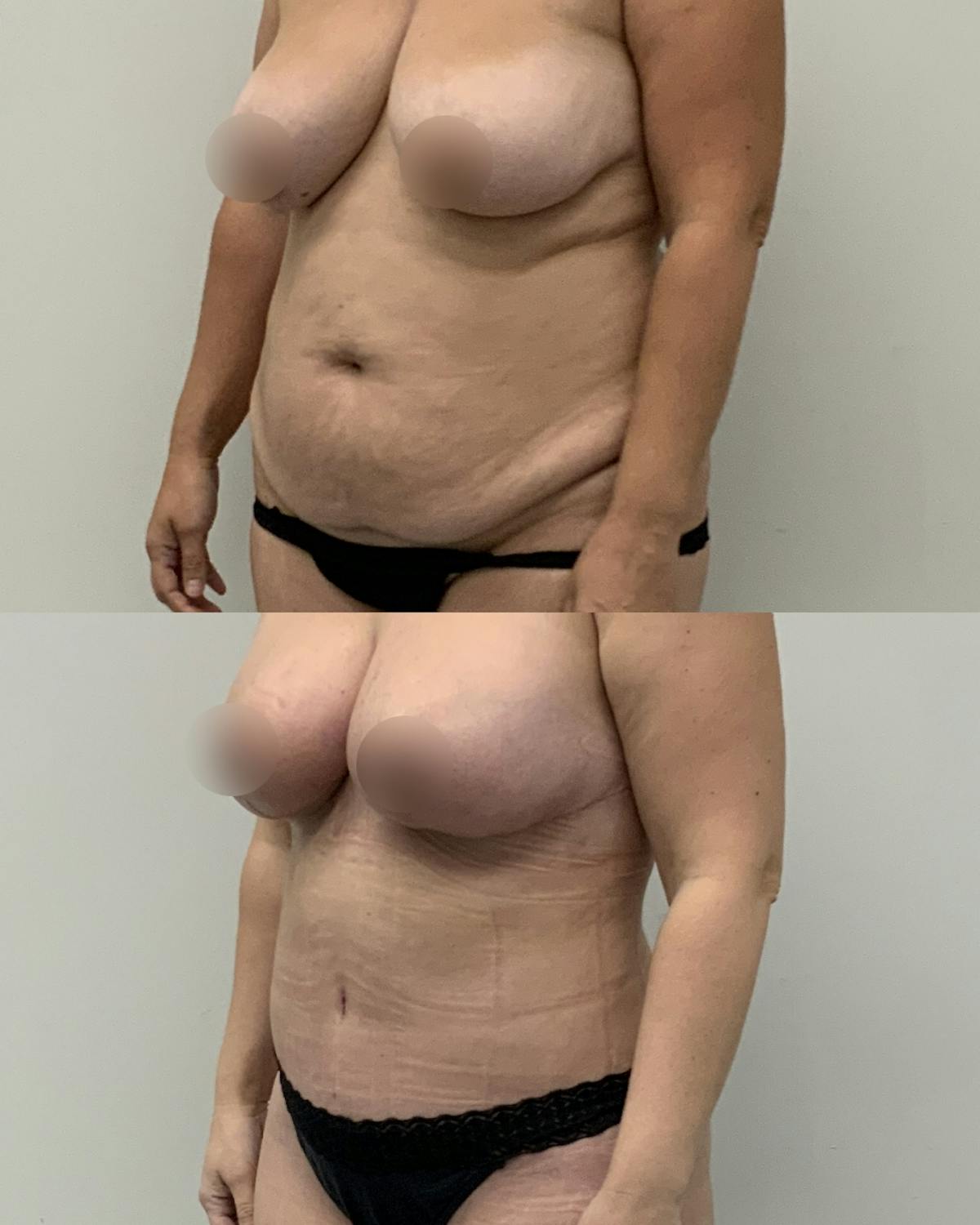 Tummy Tuck Before & After Gallery - Patient 322946 - Image 2