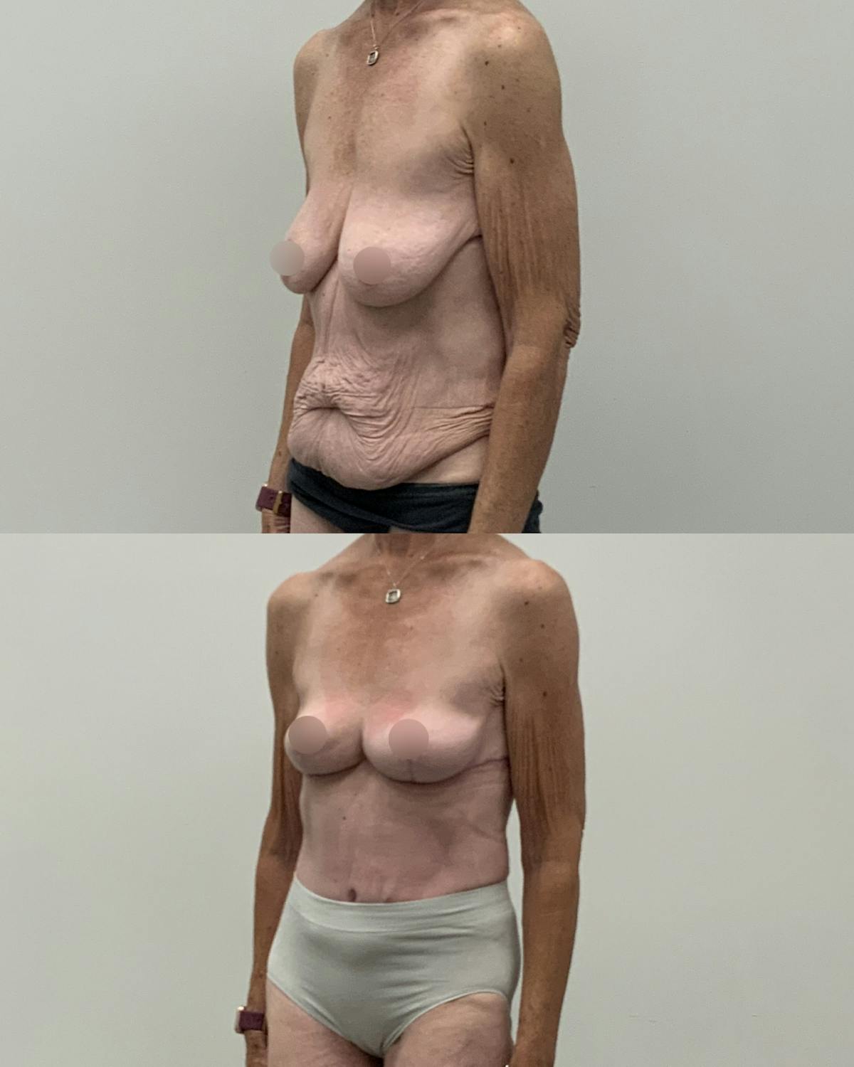 Mommy Makeover Before & After Gallery - Patient 130710 - Image 2