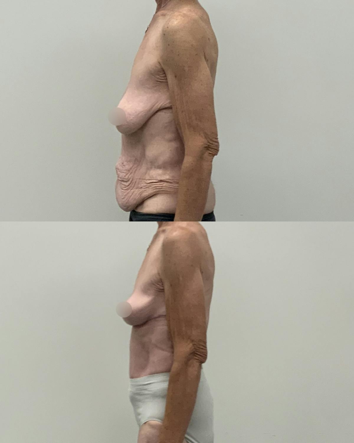 Mommy Makeover Before & After Gallery - Patient 130710 - Image 3