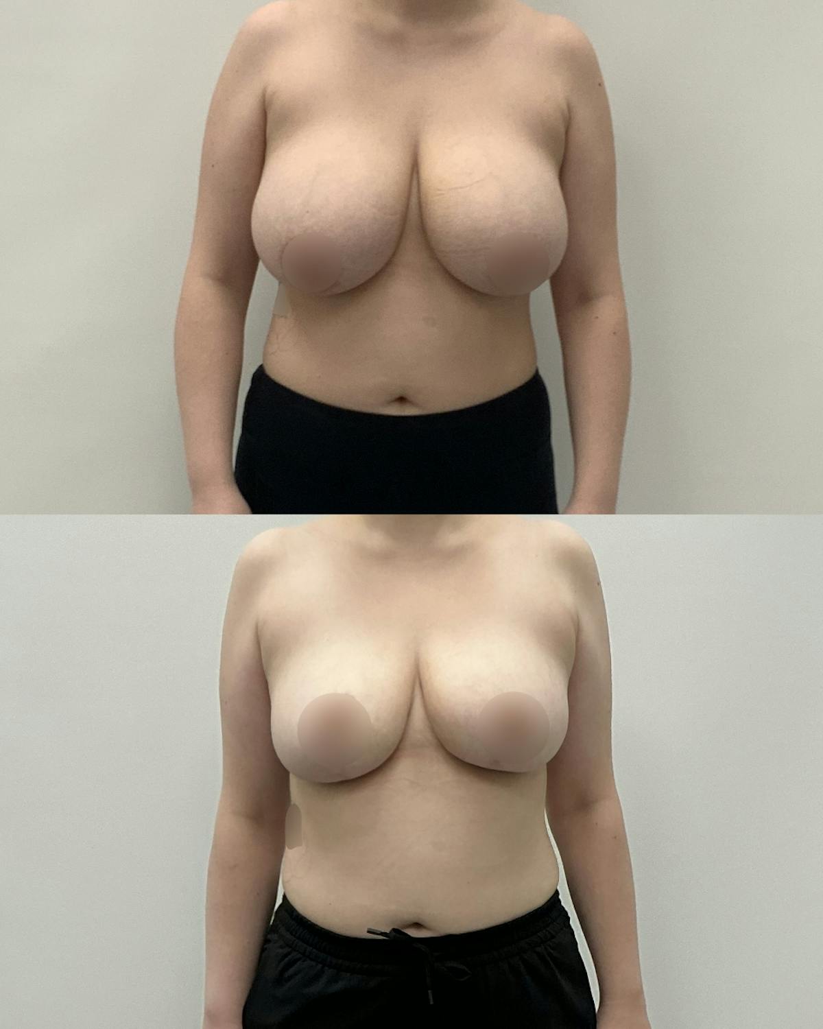 Breast Reduction Before & After Gallery - Patient 300327 - Image 1