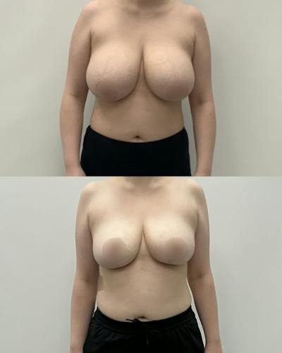 Breast Lift Before & After Gallery - Patient 362956 - Image 1