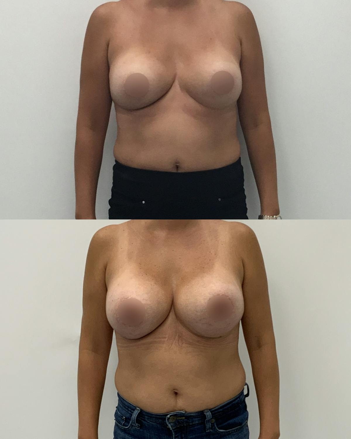 Breast Augmentation Before & After Gallery - Patient 214158 - Image 1