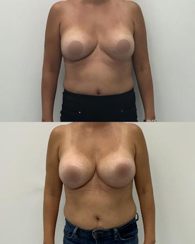 Breast Augmentation Before & After Gallery - Patient 214158 - Image 1