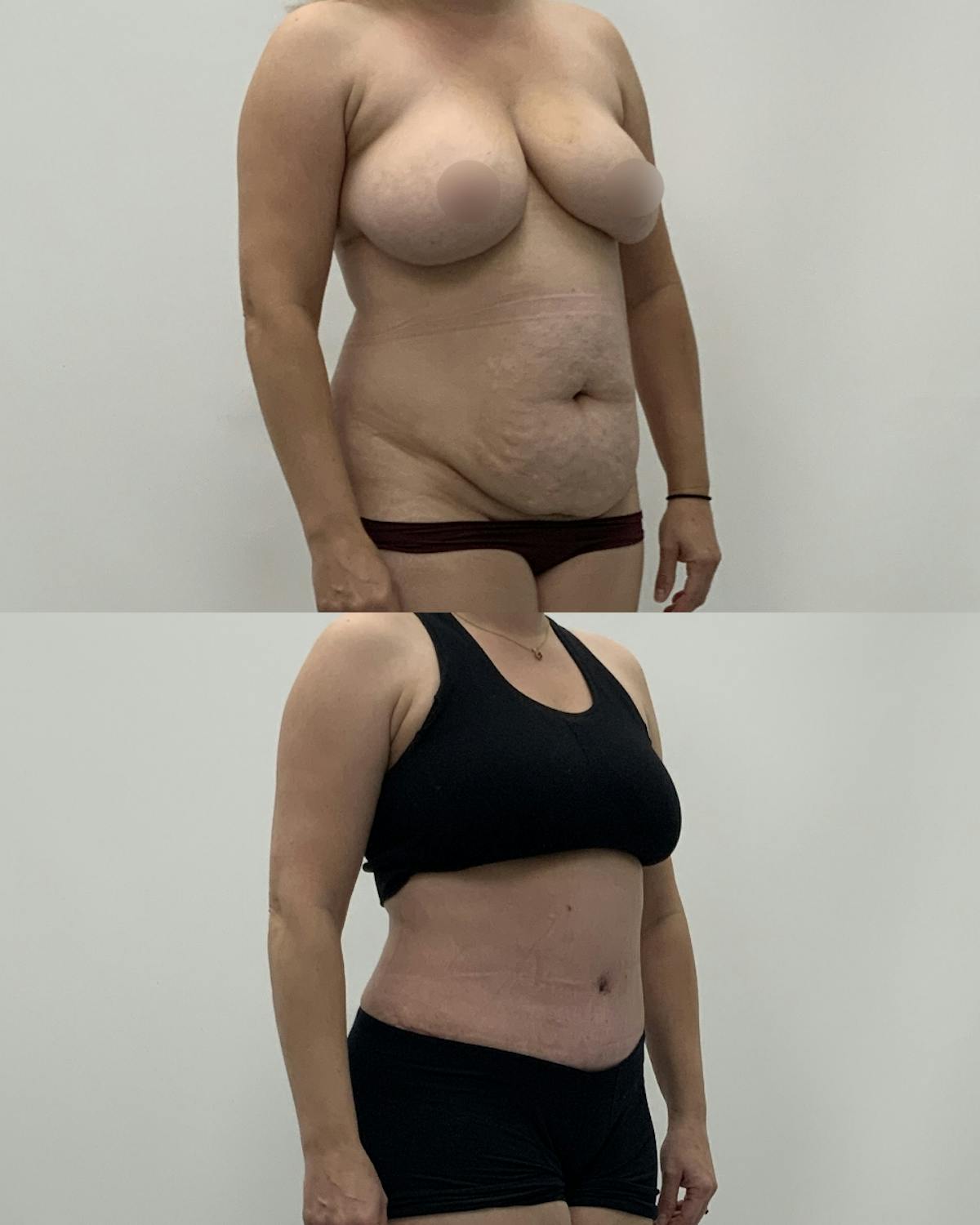 Tummy Tuck Before & After Gallery - Patient 419560 - Image 2
