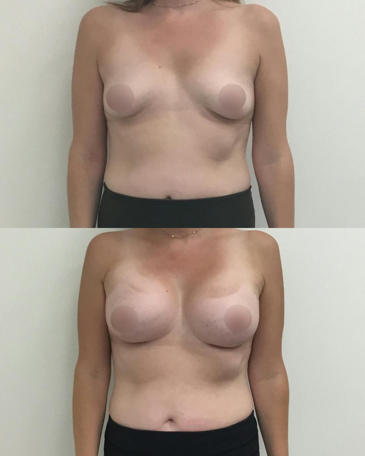 Breast Augmentation Before & After Gallery - Patient 235091 - Image 1