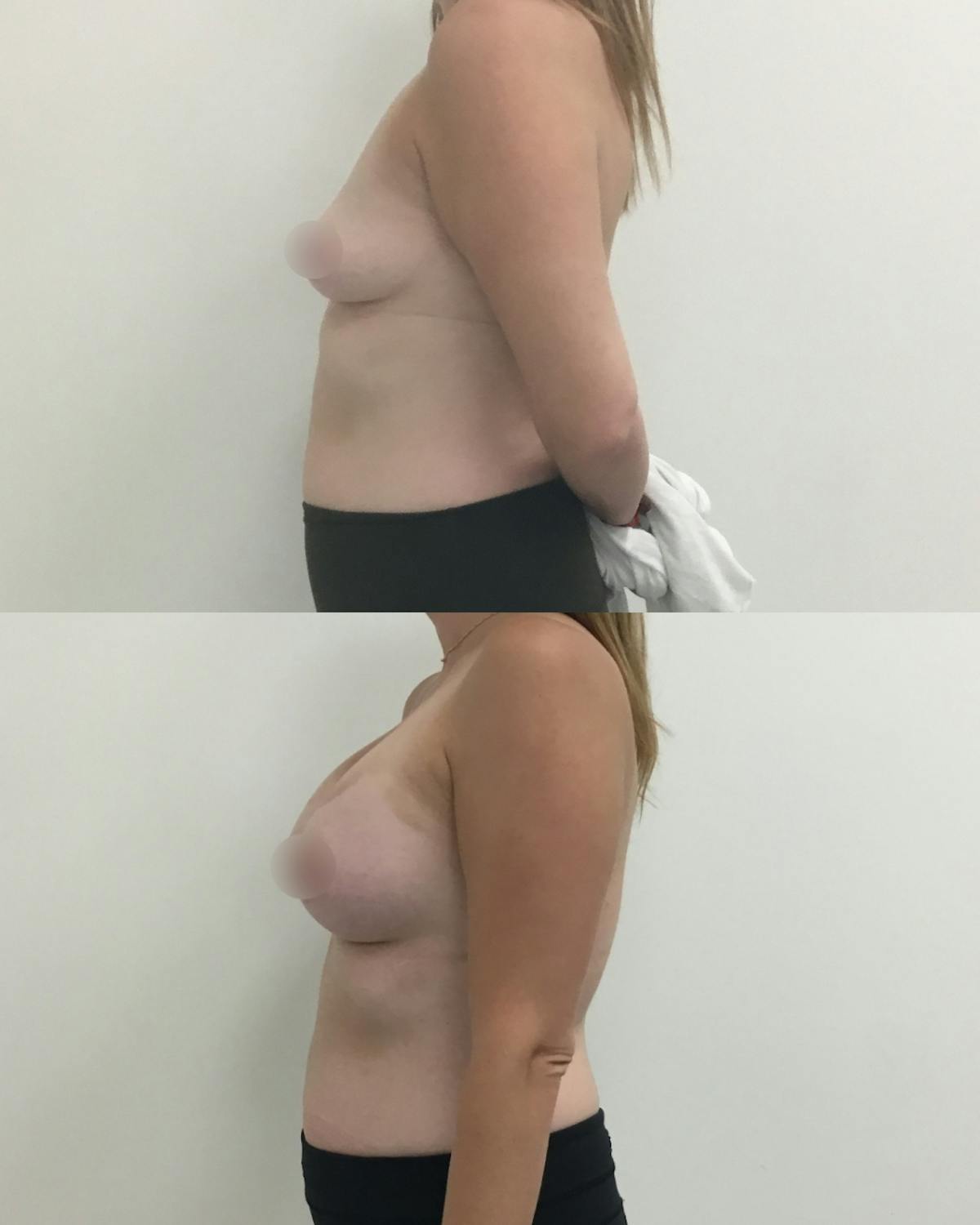 Breast Augmentation Before & After Gallery - Patient 235091 - Image 3