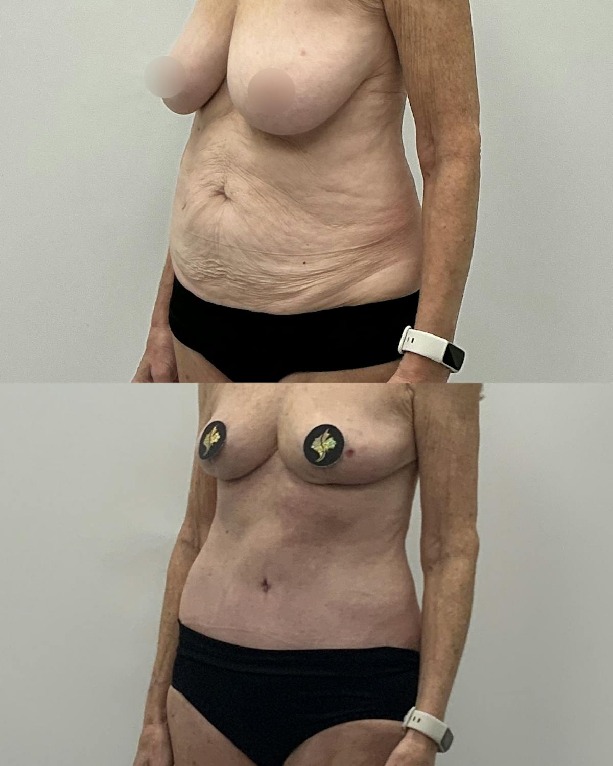 Tummy Tuck Before & After Gallery - Patient 543276 - Image 2