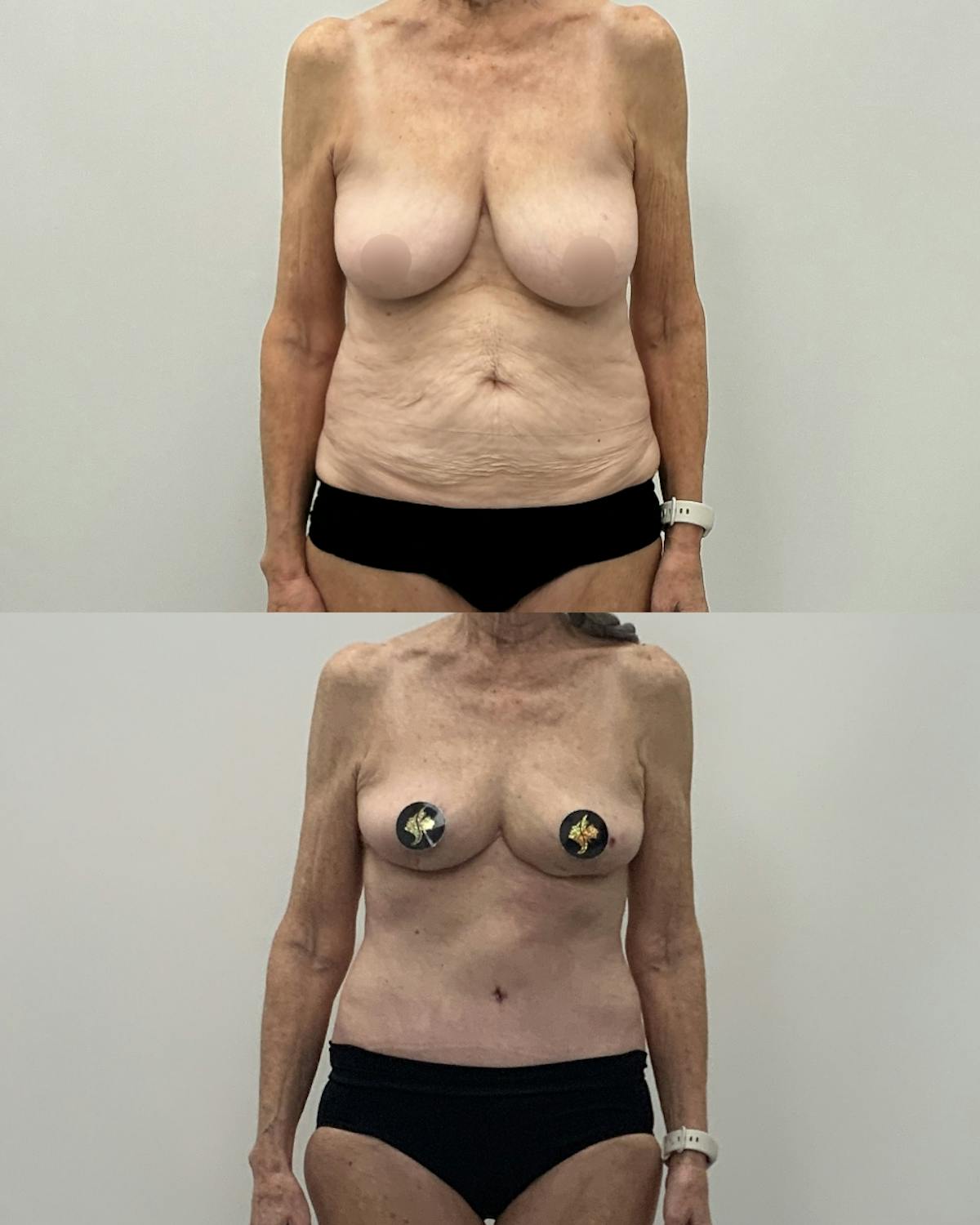 Mommy Makeover Before & After Gallery - Patient 297587 - Image 1
