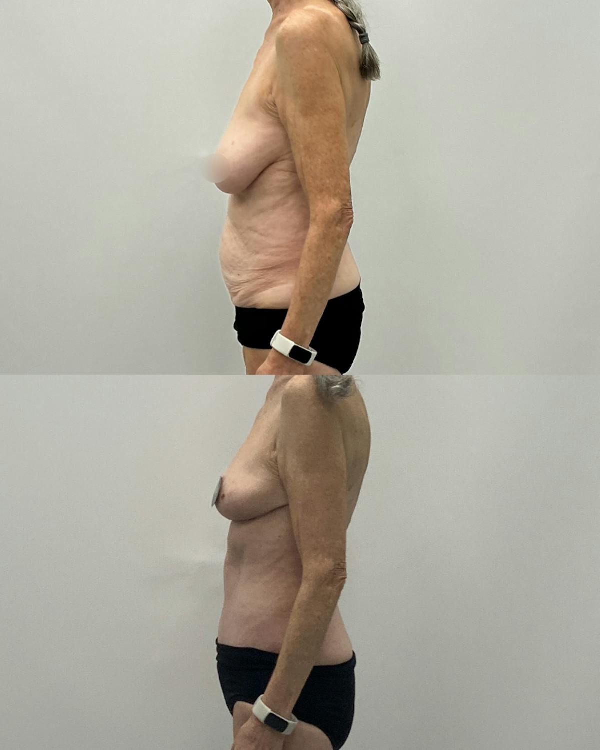 Mommy Makeover Before & After Gallery - Patient 297587 - Image 3