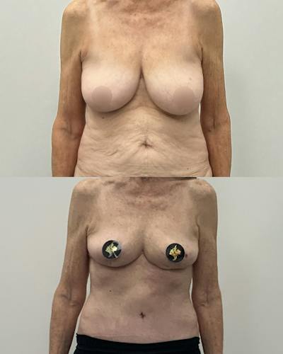 Breast Lift Before & After Gallery - Patient 137965 - Image 1