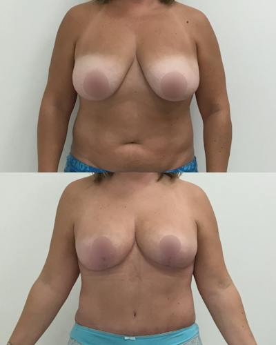Breast Lift Before & After Gallery - Patient 803682 - Image 1