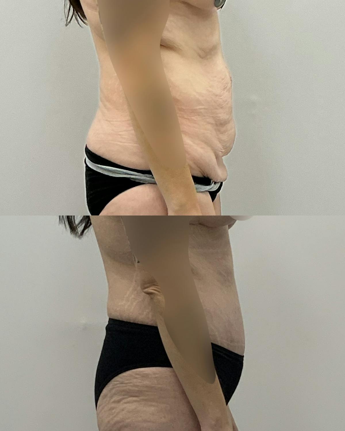 Tummy Tuck Before & After Gallery - Patient 371611 - Image 3