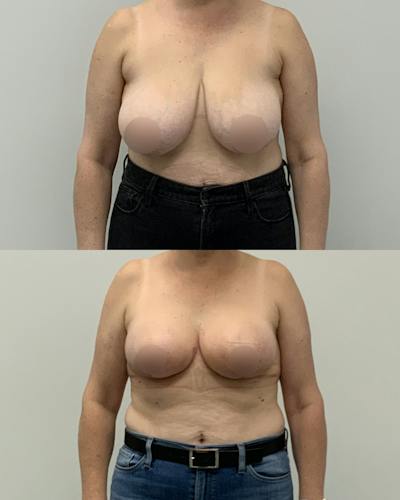Breast Lift Before & After Gallery - Patient 388774 - Image 1