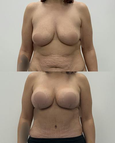 Breast Lift Before & After Gallery - Patient 618661 - Image 1