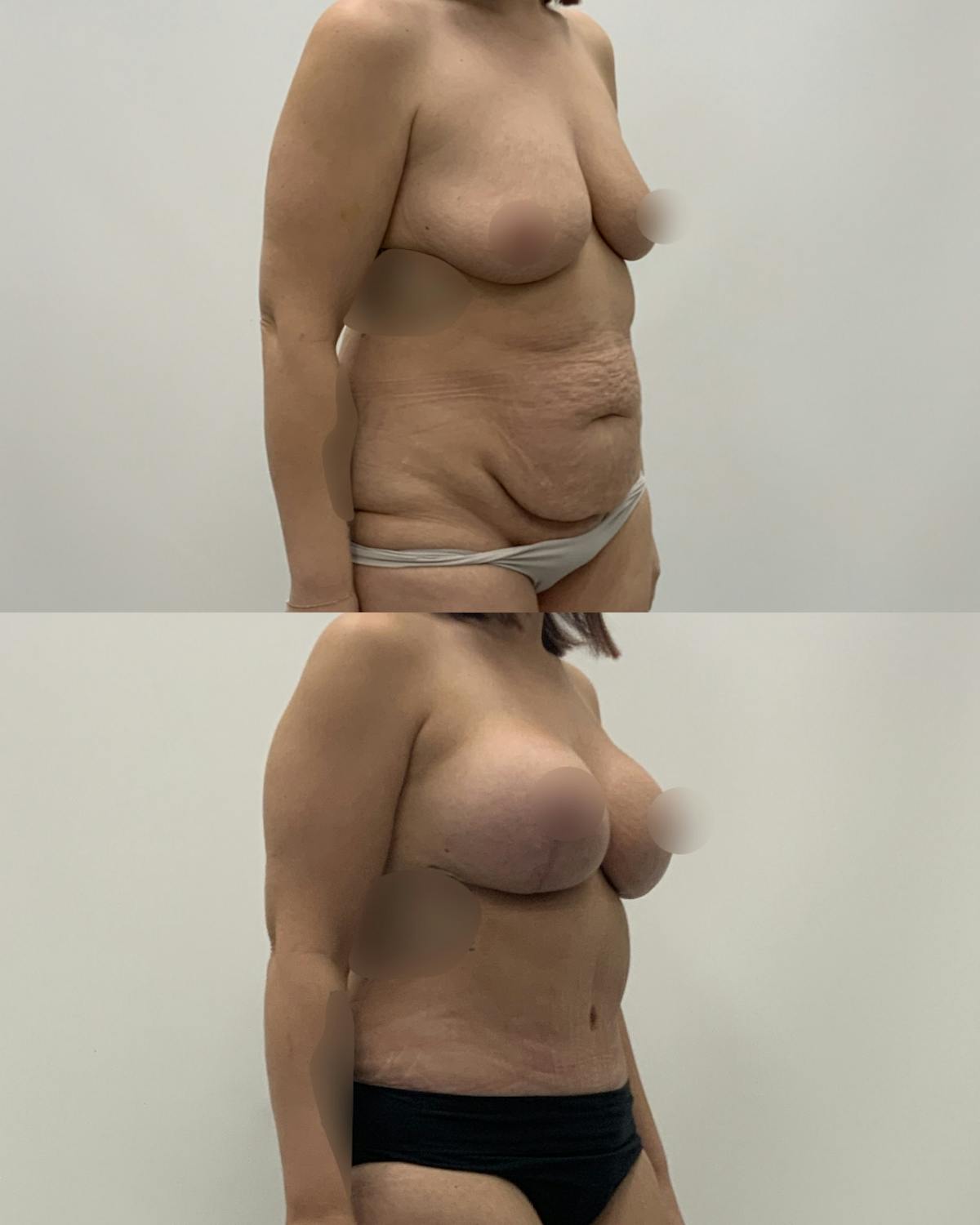 Mommy Makeover Before & After Gallery - Patient 117892 - Image 2