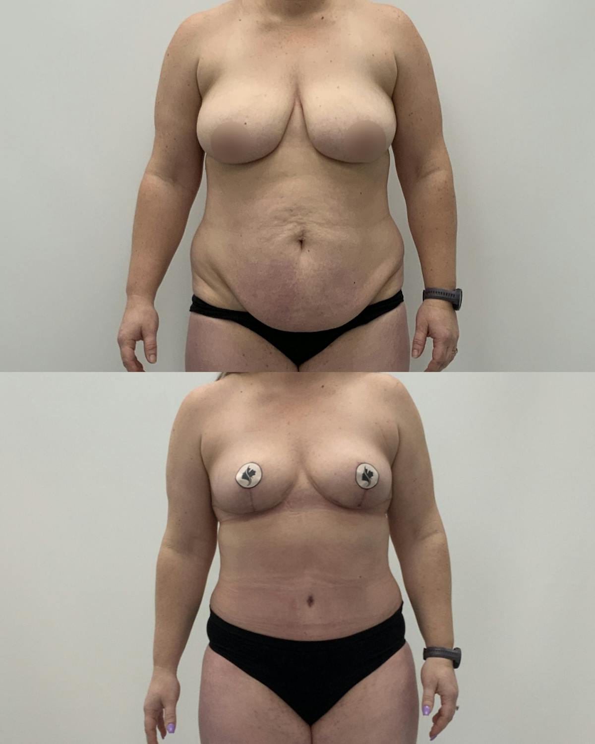 Mommy Makeover Before & After Gallery - Patient 243223 - Image 1