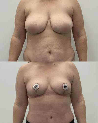 Breast Reduction Before & After Gallery - Patient 238910 - Image 1