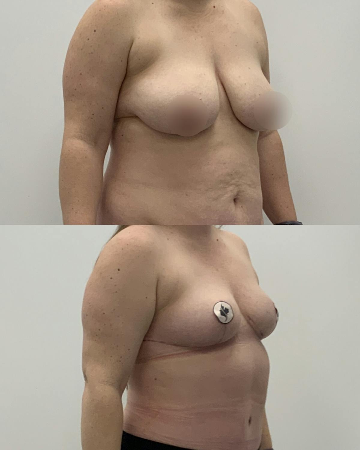 Breast Reduction Before & After Gallery - Patient 238910 - Image 2