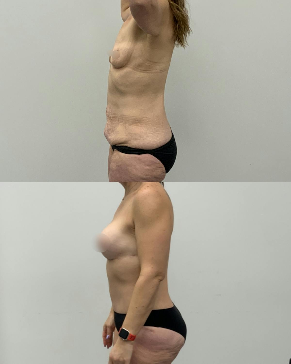 Mommy Makeover Before & After Gallery - Patient 165075 - Image 3