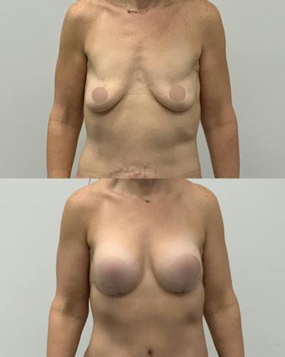 Breast Lift Before & After Gallery - Patient 160021 - Image 1
