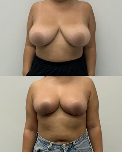 Breast Lift Before & After Gallery - Patient 159248 - Image 1
