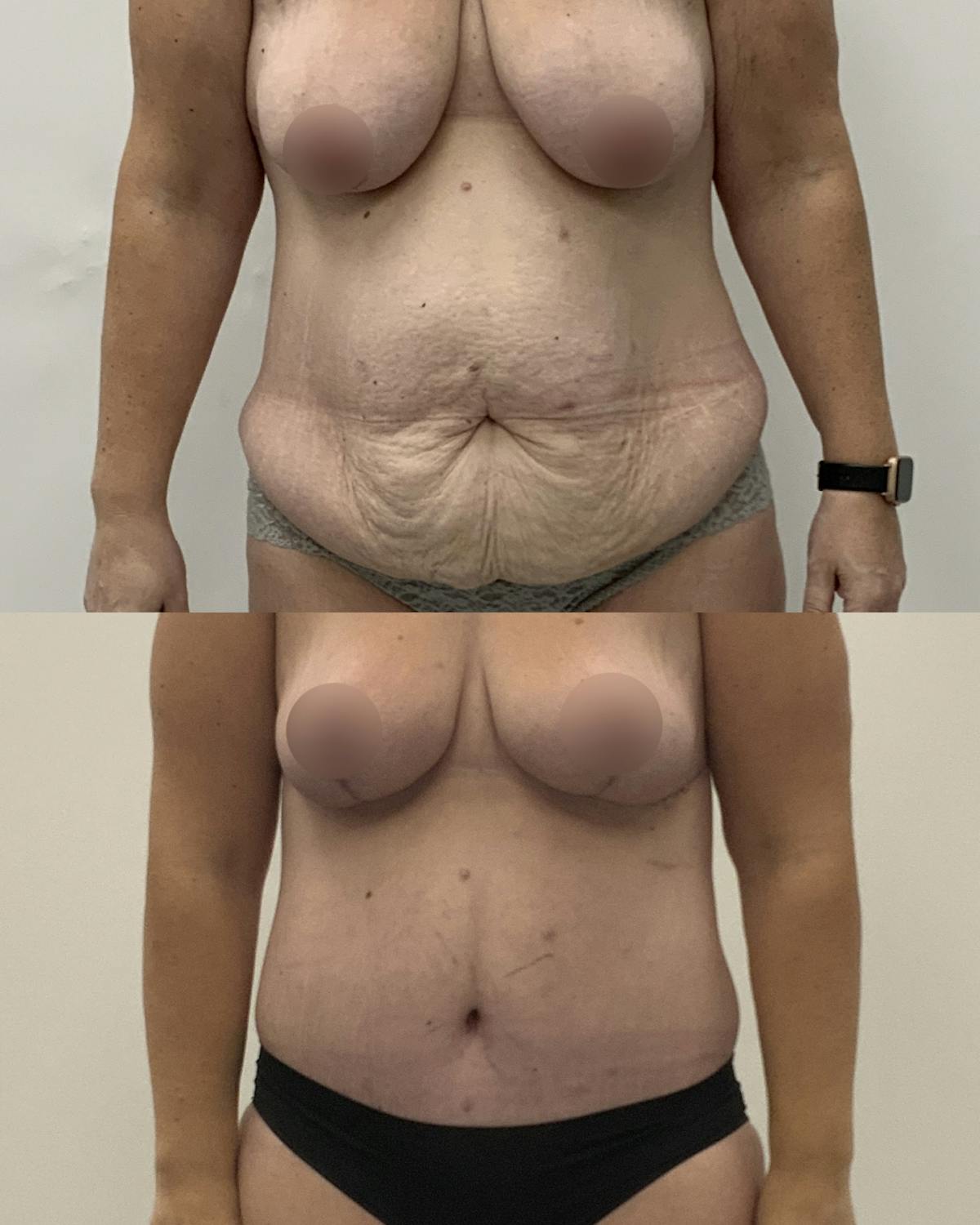 Tummy Tuck Before & After Gallery - Patient 183315 - Image 1