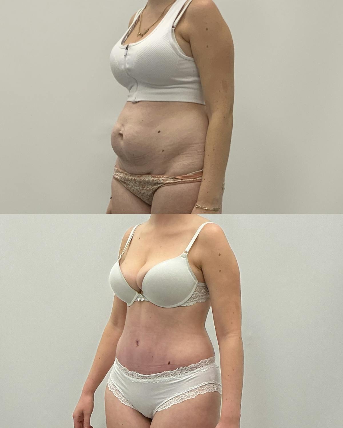 Tummy Tuck Before & After Gallery - Patient 305297 - Image 2