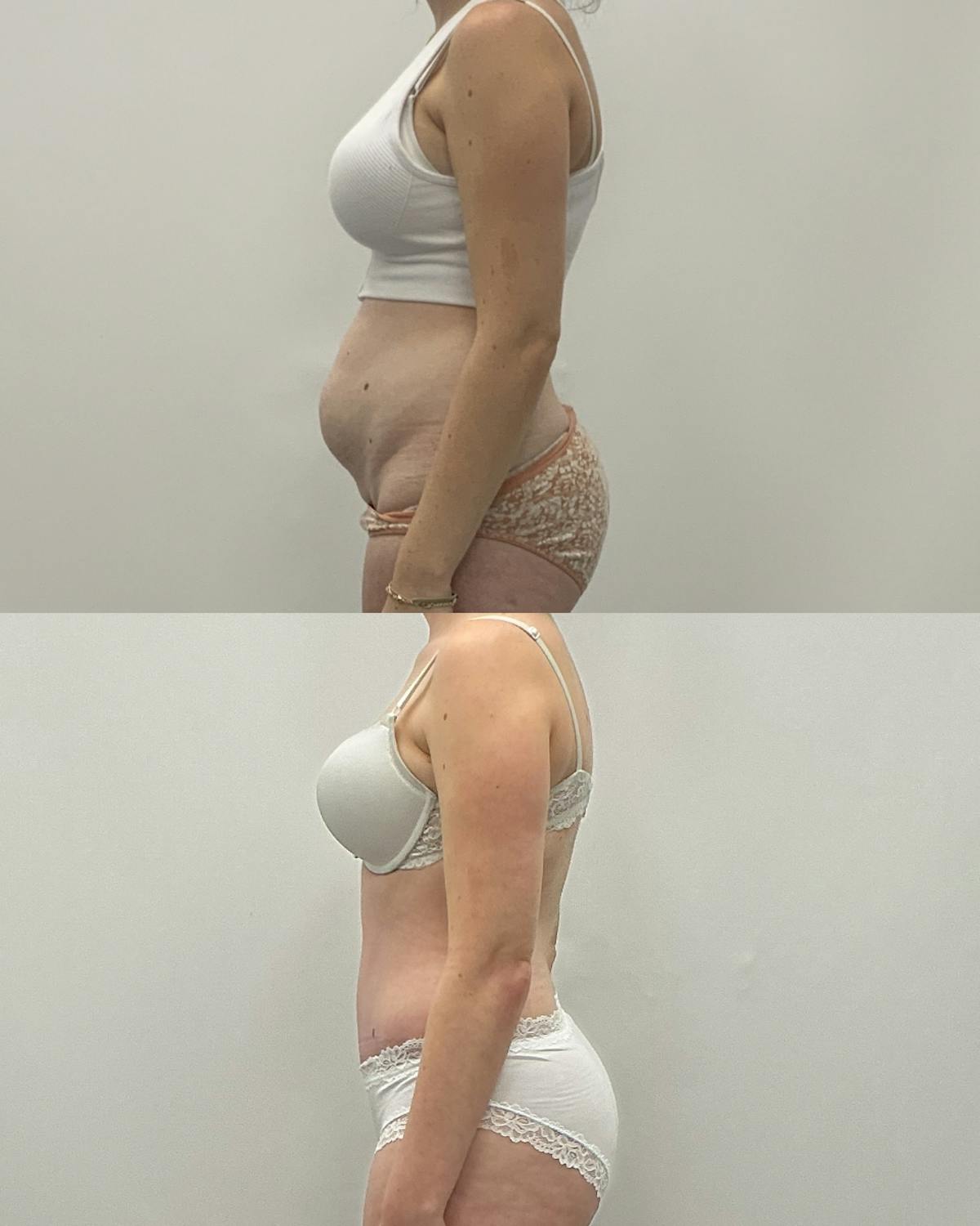 Tummy Tuck Before & After Gallery - Patient 305297 - Image 3