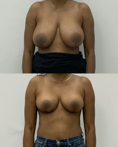 Breast Lift Before & After Gallery - Patient 137563 - Image 1