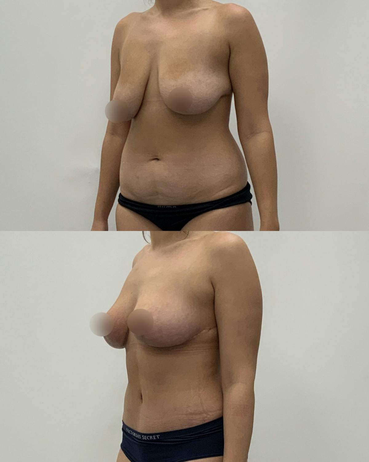 Mommy Makeover Before & After Gallery - Patient 919986 - Image 2