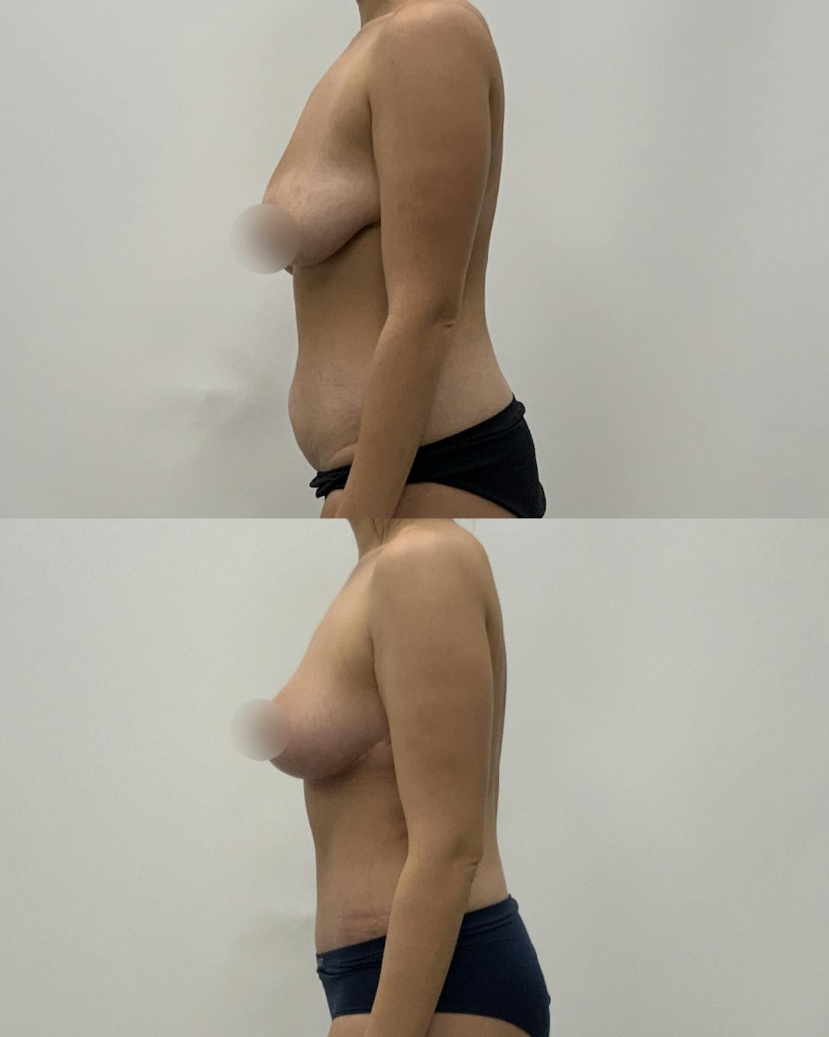 Mommy Makeover Before & After Gallery - Patient 919986 - Image 3