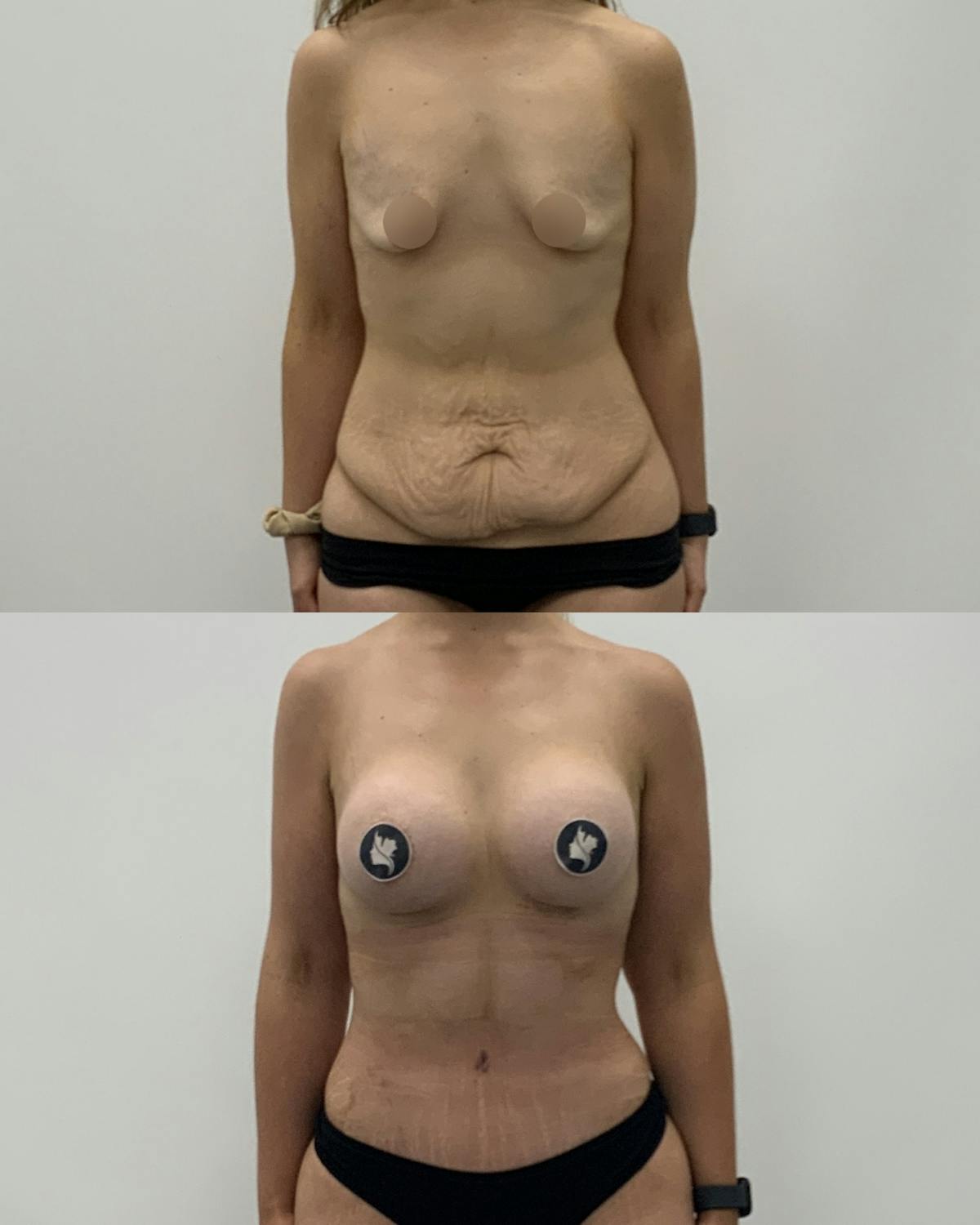 Mommy Makeover Before & After Gallery - Patient 417553 - Image 1