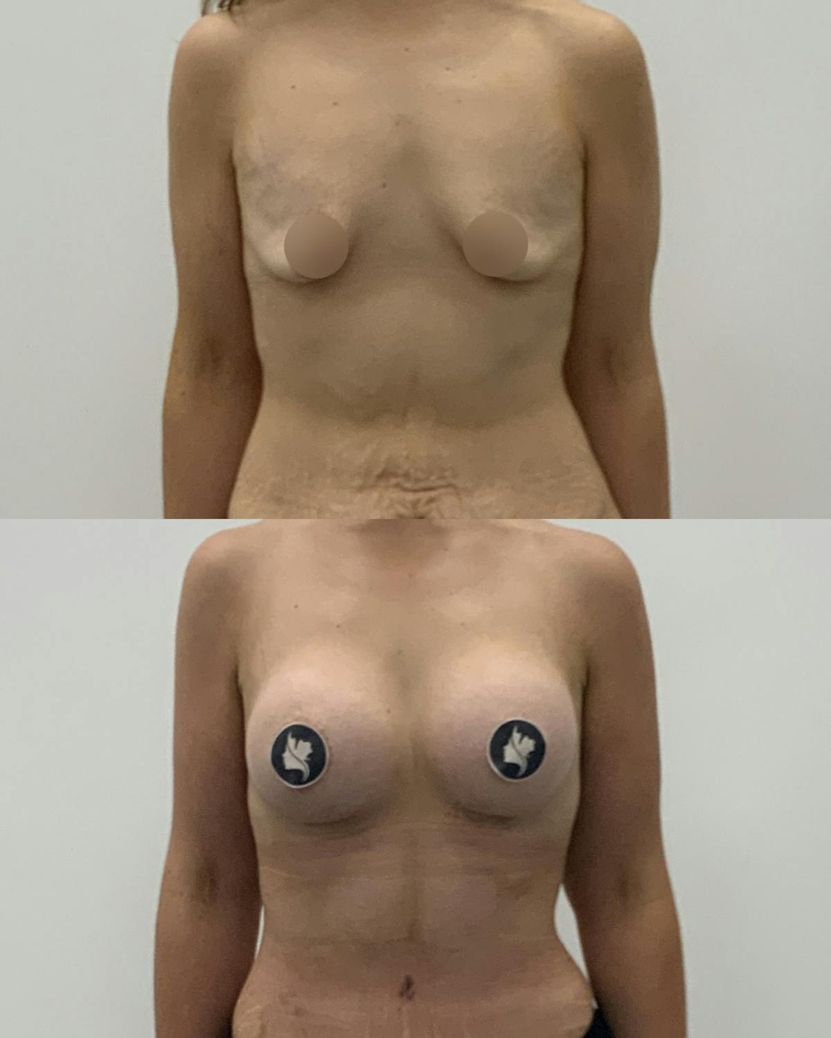 Breast Augmentation Before & After Gallery - Patient 370366 - Image 1