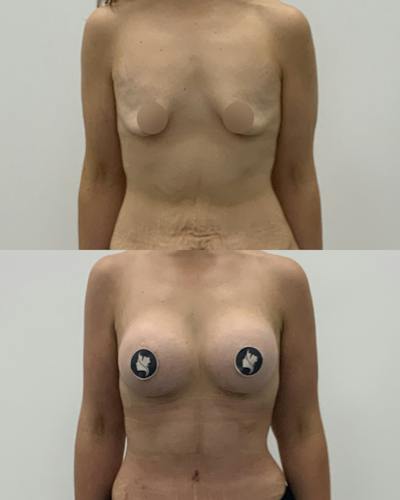 Breast Augmentation Before & After Gallery - Patient 370366 - Image 1