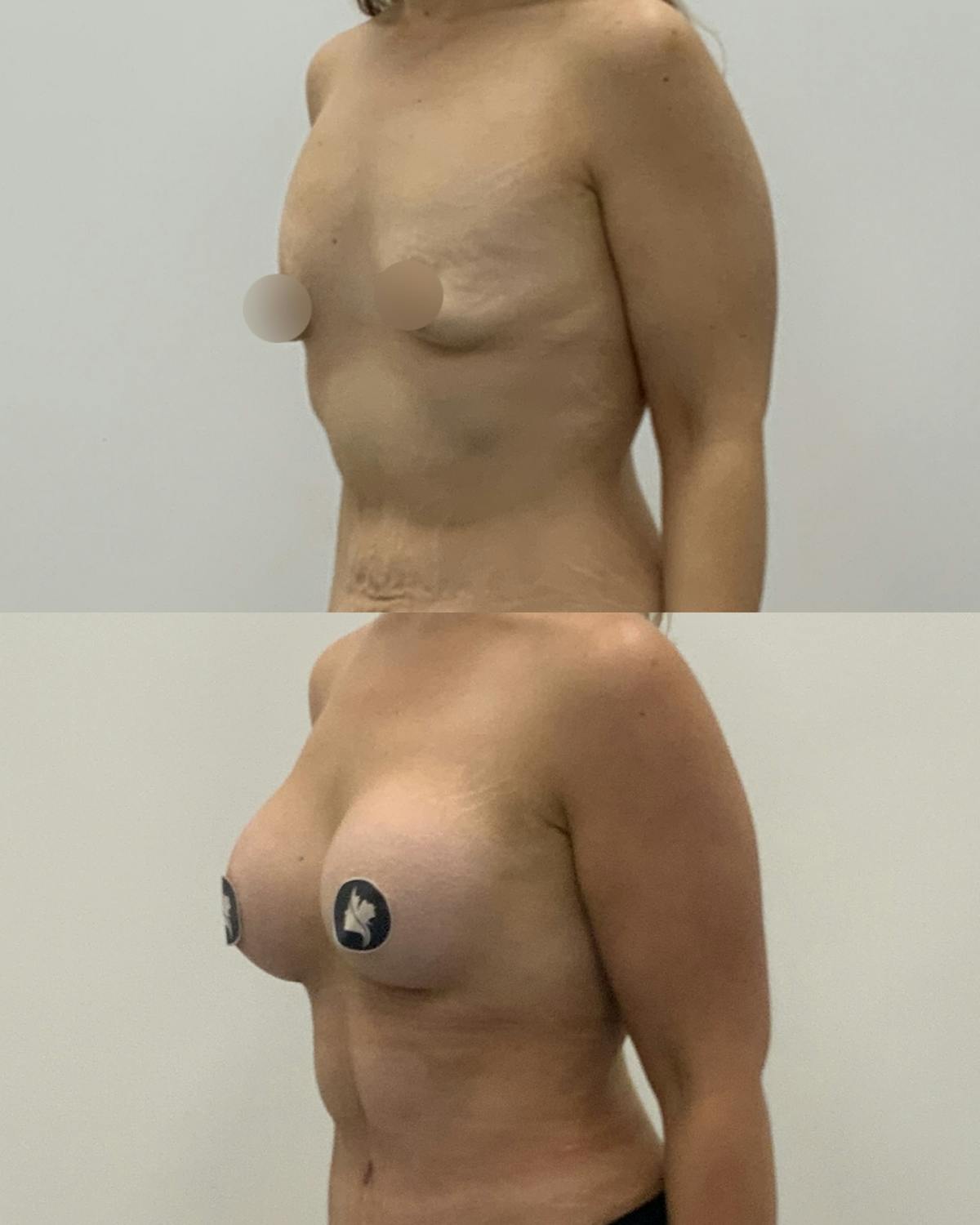 Breast Augmentation Before & After Gallery - Patient 370366 - Image 2