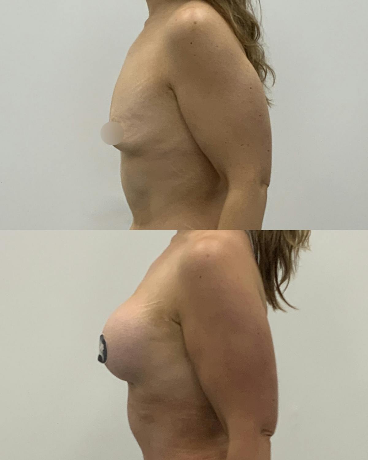 Breast Augmentation Before & After Gallery - Patient 370366 - Image 3