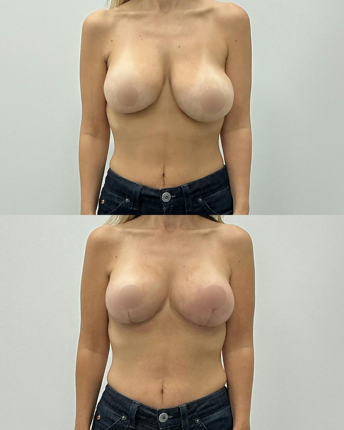 Breast Reduction Before & After Gallery - Patient 202109 - Image 1