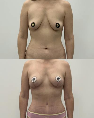 Breast Lift Before & After Gallery - Patient 166485 - Image 1