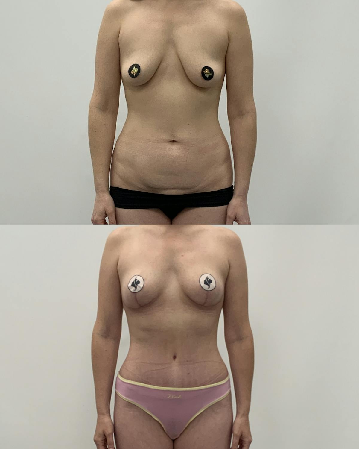 Mommy Makeover Before & After Gallery - Patient 320626 - Image 1