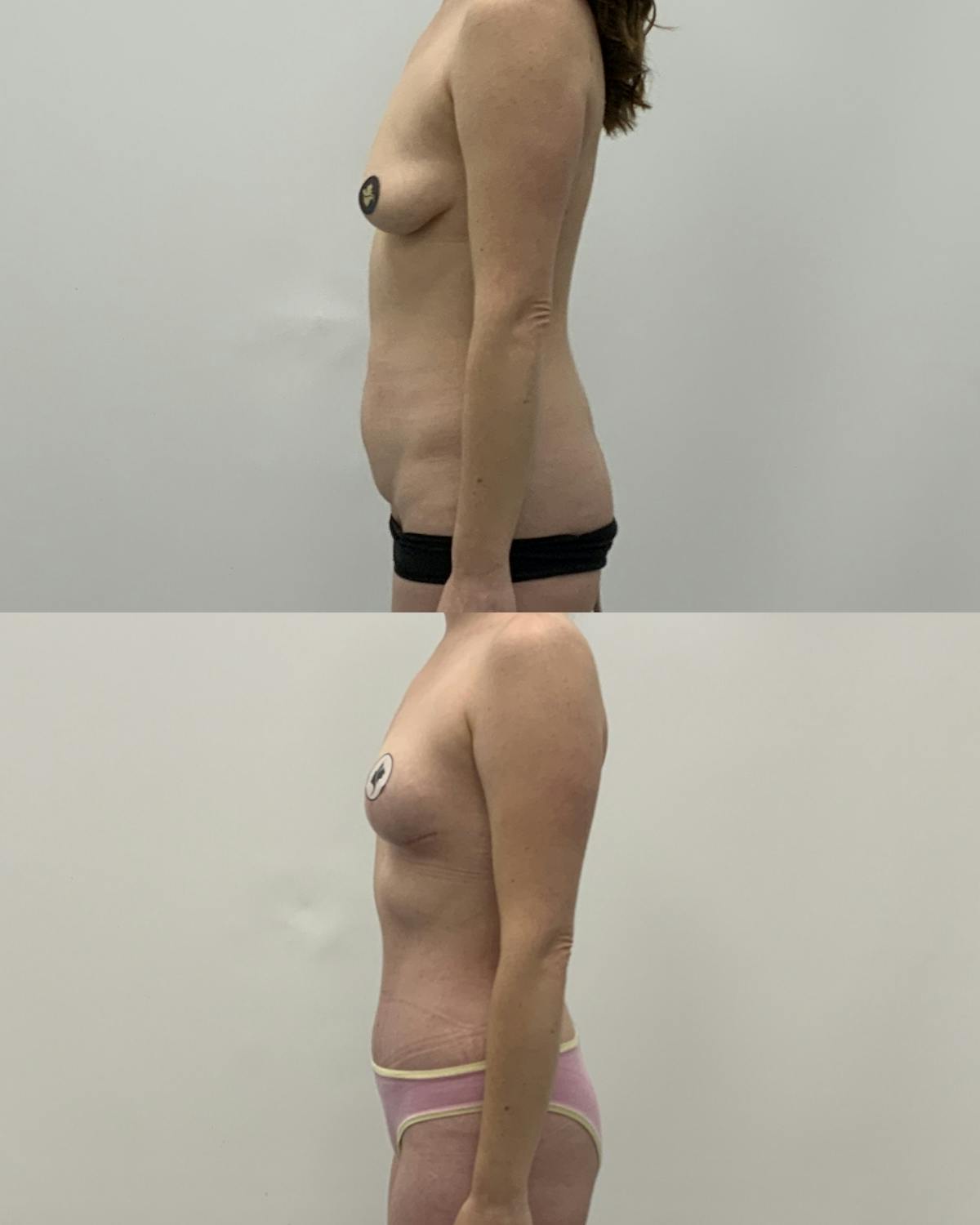 Mommy Makeover Before & After Gallery - Patient 320626 - Image 3