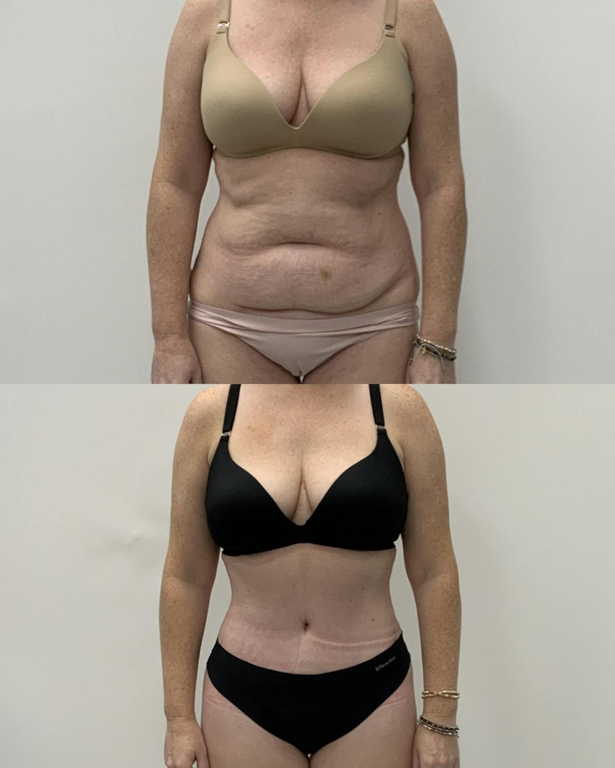 Tummy Tuck Before & After Gallery - Patient 758213 - Image 1