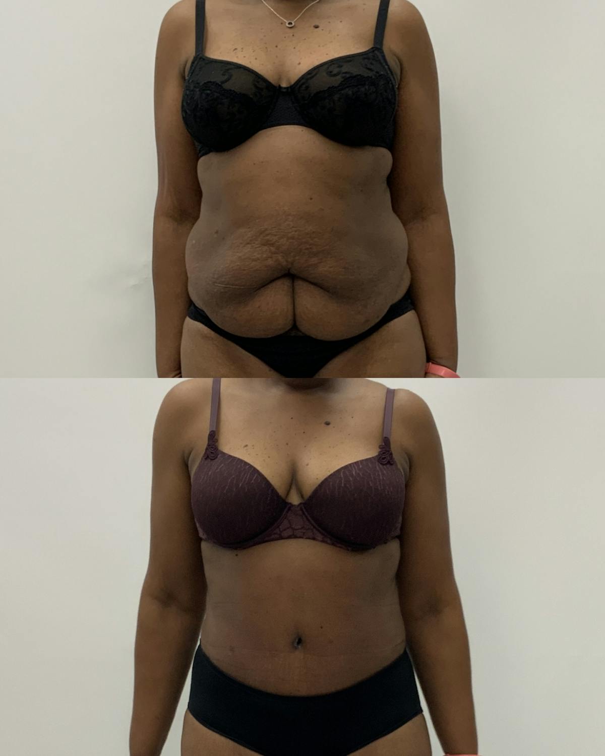 Tummy Tuck Before & After Gallery - Patient 360544 - Image 1