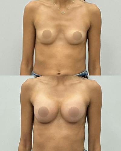 Breast Augmentation Before & After Gallery - Patient 602416 - Image 1