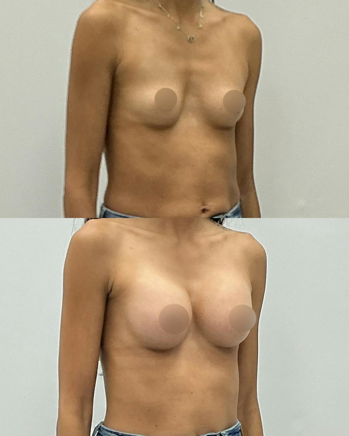 Breast Augmentation Before & After Gallery - Patient 602416 - Image 2