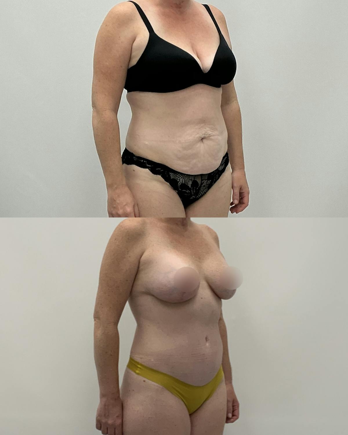 Mommy Makeover Before & After Gallery - Patient 383866 - Image 2