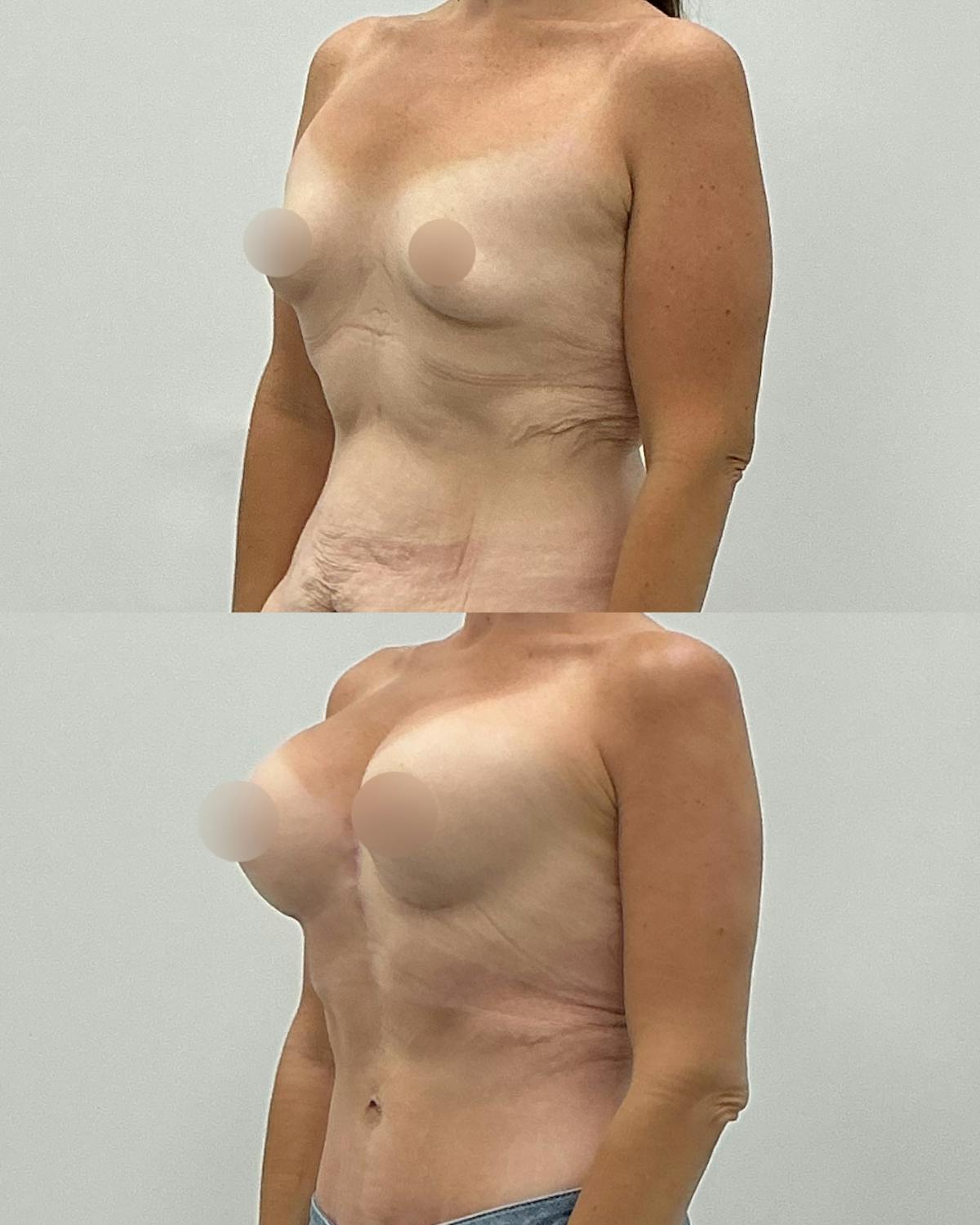 Breast Augmentation Before & After Gallery - Patient 193305 - Image 2