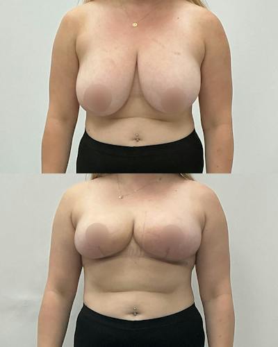 Breast Lift Before & After Gallery - Patient 206961 - Image 1